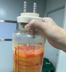 乌鲁木齐水动力吸脂手术要做多久？
